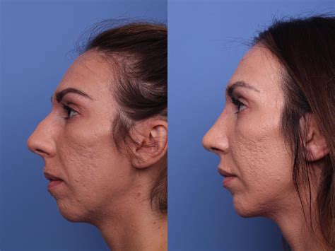 Chin Implant Before and After Pictures Case 375 | Scottsdale, AZ ...