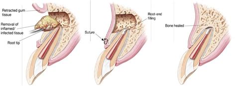 Endodontic Surgery (Apicoectomy) Plymouth MN