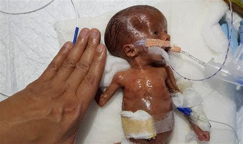 Baby born 14 weeks prematurely, one of the smallest to survive abdominal surgery - Daily Active