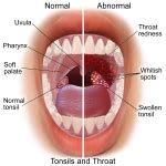 Strep Throat VS Sore Throat - Causes, Treatments, Preventions