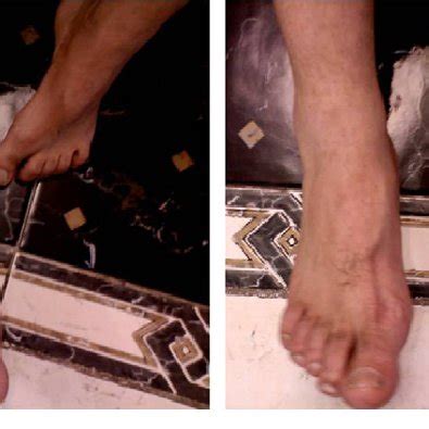 Equinovarus deformity with flexion of toes. Before (A) and after (B)... | Download Scientific ...