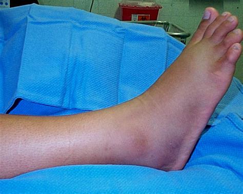 Ankle Fractures - Tyler, TX | Podiatrist