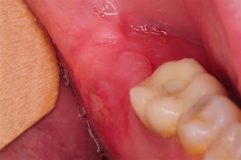 Infection one month after wisdom tooth extraction | healthlines