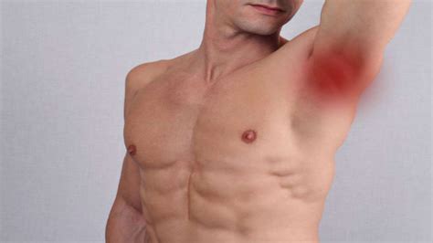 Armpit Pimple Types Causes And Treatments - vrogue.co