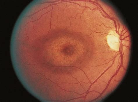 Cone dystrophy - American Academy of Ophthalmology