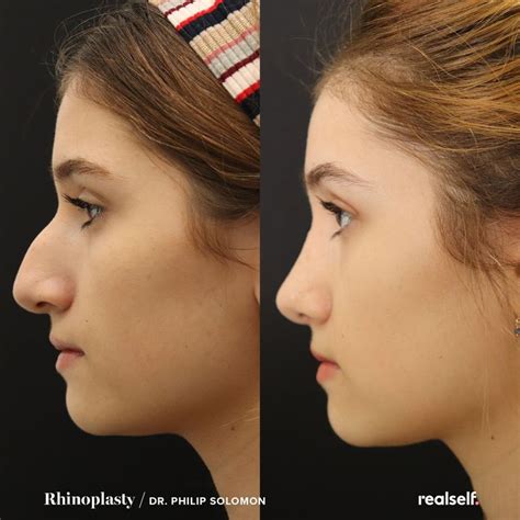 One Woman’s Rhinoplasty: Before, During, and After Nose Plastic Surgery ...