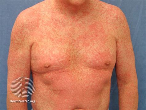 Lamictal Rash: Early Stages, Location, and Treatments
