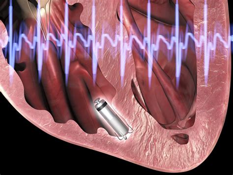 Leadless Pacemakers "Lead" the Way to Fewer Complications in Cardiac Arrhythmias - The ...