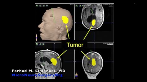 Brain Surgery: Removal of brain tumor after radiosurgery, with ...