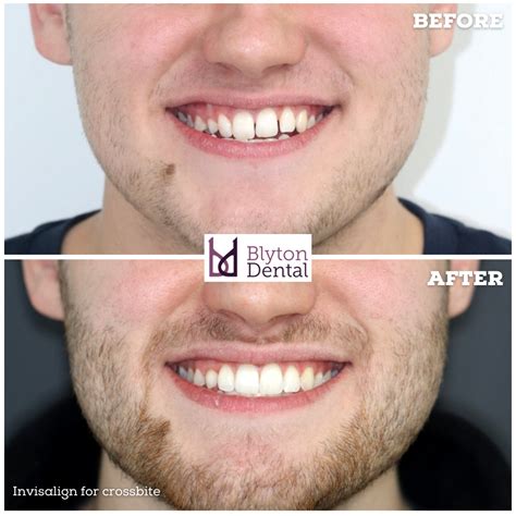 Invisalign for crossbite — Blyton Dental