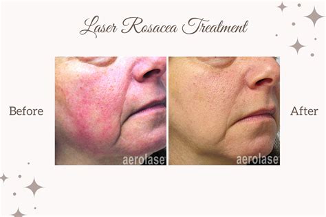 Why Use Laser For Rosacea Treatment? — TaVieMD MedSpa