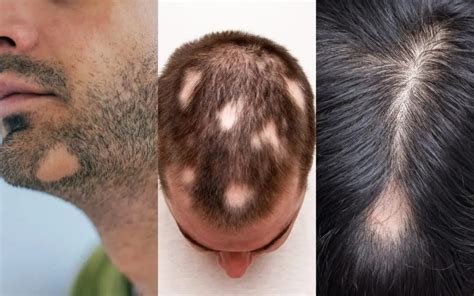 Alopecia Bald Spot | vlr.eng.br