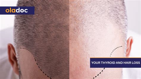 Your Thyroid And Hair Loss | Thyroid Care | oladoc.com