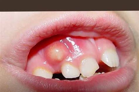 Stomatitis in children on the gums (8 photos): the gums bleed, inflamed