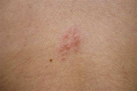 Top 19 stages of shingles rash pictures 2022
