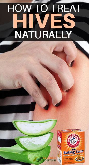 How to Treat Hives Naturally #hives #treat #naturally http://allergy ...