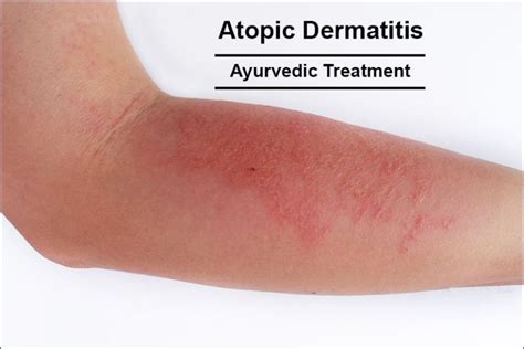 How to Treat Atopic Dermatitis in Ayurveda Naturally?