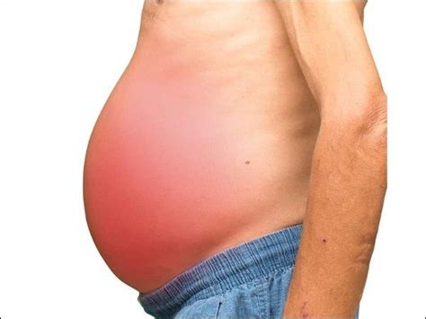 Ascites and Its Treatment - Diet and Herbal Remedies