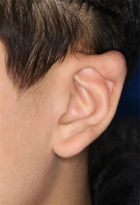 Figure 1 from A rare development of tumoral calcinosis of the ear auricle | Semantic Scholar