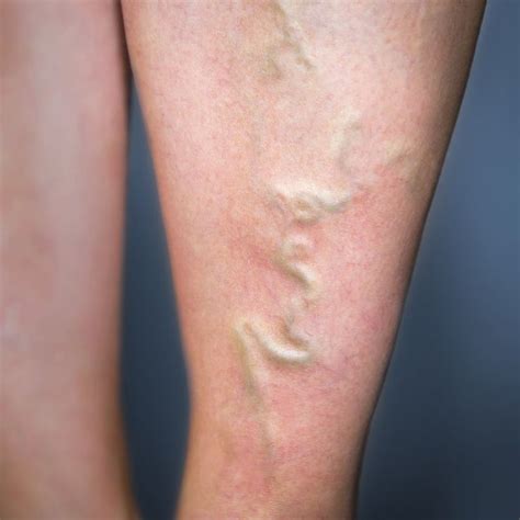 Phlebitis (5 Natural Ways to Improve Symptoms | Hormone replacement therapy, Varicose veins ...