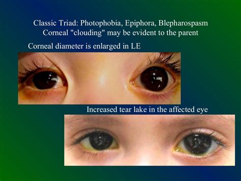 Congenital Glaucoma