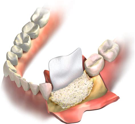 Bone Graft After Wisdom Teeth Removal: Is it necessary? - Dr. Tye