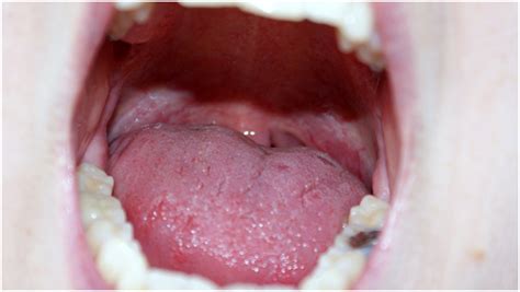 What is oral HPV? | CARROUSA