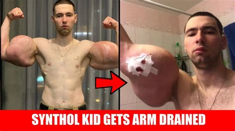 Synthol Kid Gets 3 Liters of Jelly Drained from Arm - YouTube