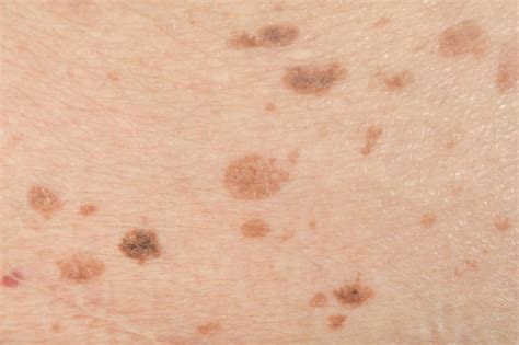 Liver Spots Vs Skin Cancer
