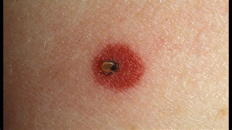 Can A Tick Bite Look Like A Scab? Quick Answer - Ecurrencythailand.com