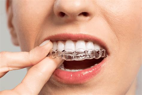 Invisalign alternative: Braces in comparison – important things to know ...