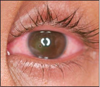 Metallic Corneal Foreign Body With Rust Ring | Consultant360