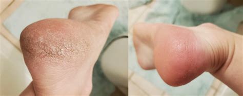 12 Best Dry Feet & Cracked Skin Remedies (Cheap & Effective Solutions!)