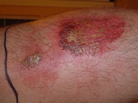 What does infected road rash look like - sanycrm