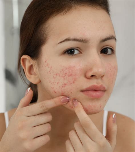 Vitamin D For Acne: Benefits, How To Use, And Side Effects