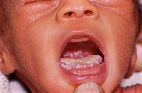 Oral Thrush In Aids Baby Photograph by Dr M.a. Ansary/science Photo ...