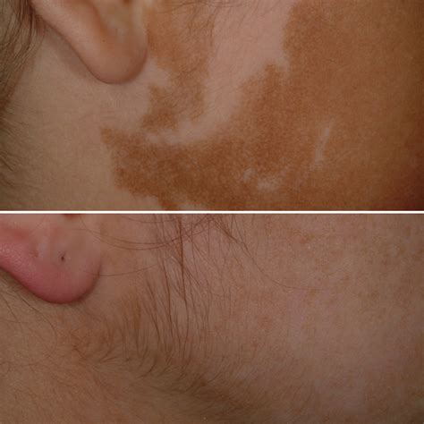 Birthmark laser treatment — Physicians Laser and Dermatology Institute