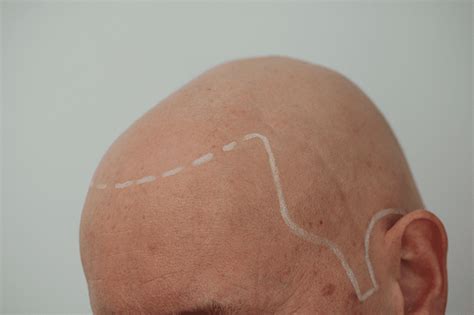 Alopecia universalis: Complete hair loss all over the body