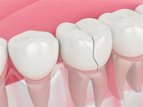 Can I Ignore a Cracked Tooth if it Doesn't Hurt? | Your Time Dental