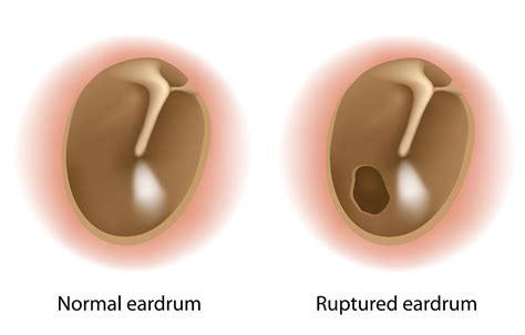 Ear Drum Perforations: Doc, is there a hole in my ear drum?