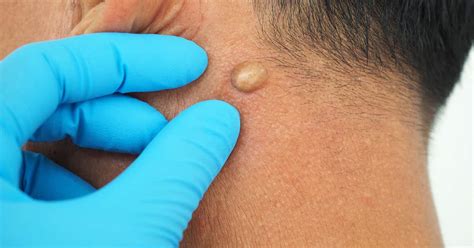 Sebaceous Cysts: All you need to know – Derma Essentia