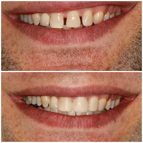 All 102+ Images Veneers Before And After Pictures Full HD, 2k, 4k