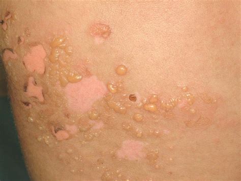 Erythema Toxicum Vs Pustular Melanosis