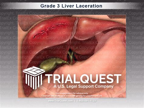 Liver Laceration Grades