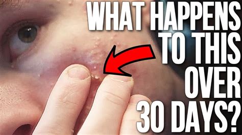 pop a cyst Archives - Pimple Popping Videos