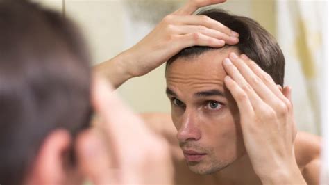 Are You Losing Hair From Temples? Know It’s Causes And How To Deal With It | OnlyMyHealth