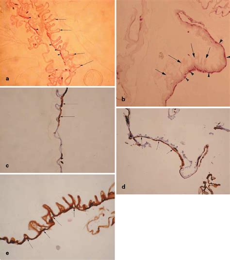 Cellophane maculopathy cases. a , b H&E staining shows hyperconvolution ...