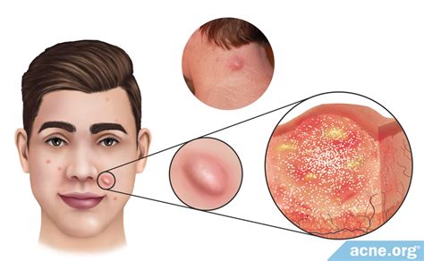 What Is an Acne Nodule? - Acne.org