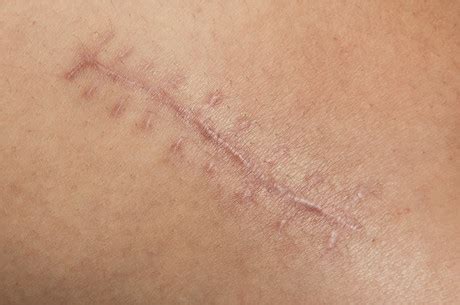 The challenge of treating scarsThe challenge of treating scars :: Hospital + Healthcare