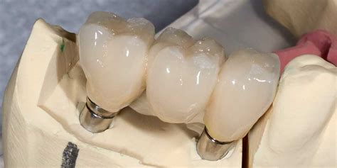 Dental Implant Supported Bridges CT | Smile Dental Center